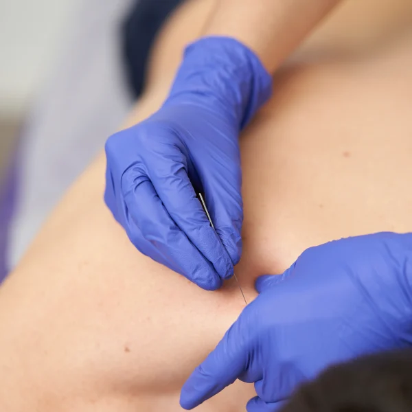 Targeted Medial Branch Block Injection in London