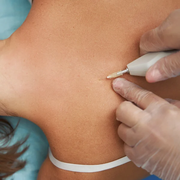 Precise Trigger Point Injection in London