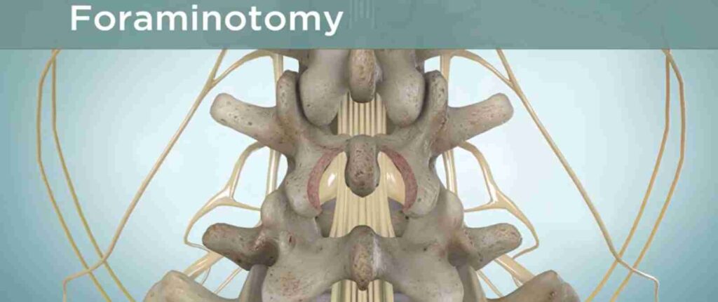 An illustration showing the foraminotomy procedure, where the surgeon removes part of the vertebral bone to relieve nerve compression