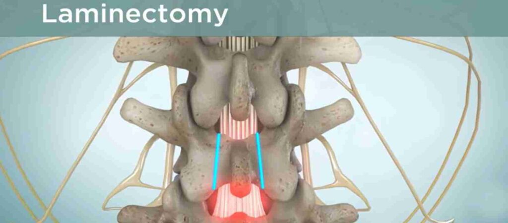 An illustration of a laminectomy procedure, showing the removal of part of the vertebral bone (lamina) to ease pressure on the spinal cord