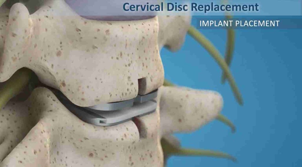 Cervical disc replacement procedure showing implant placement between spine vertebrae