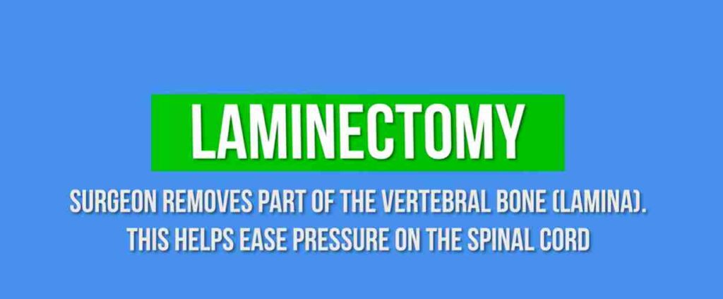 A diagram explaining laminectomy, with a visual representation of a surgeon removing part of the vertebral bone to ease pressure on the spinal cord